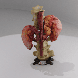 A 3D printed anatomical model of a kidney with a tumor