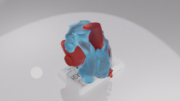 A 3D model of a heart depicting the "Chickenwing" variation of a left atrial appendage.