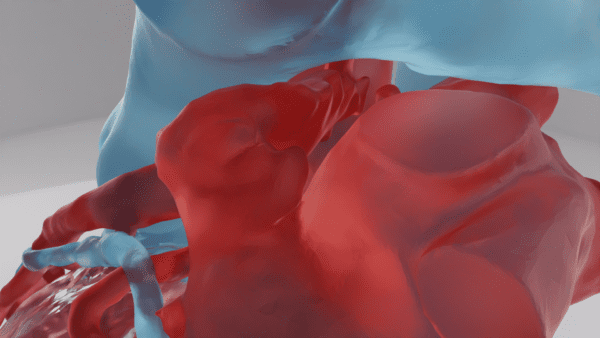 A 3D model of a heart depicting the "Chickenwing" variation of a left atrial appendage.