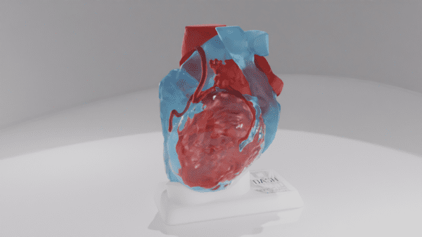 This model depicts a heart with a persistent superior left vena cava.