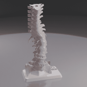 A 3D printed anatomical model of a spine with scoliosis