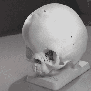 A model of a skull with bicoronal craniosynostosis