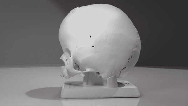 A model of a skull with bicoronal craniosynostosis