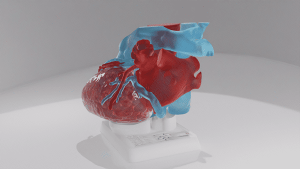 This model depicts a heart with a Left Atrial Appendage, with the "Cauliflower" variation.