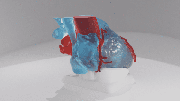 This model depicts a heart with a Left Atrial Appendage, with the "Cauliflower" variation.