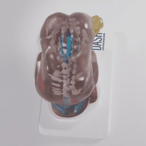 An anatomical of spina bifida meningocele