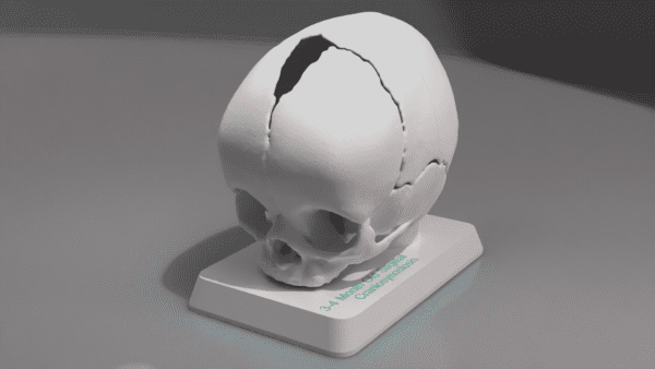 A 3D model of the skull of a 3mo with Sagittal Craniosynostosis