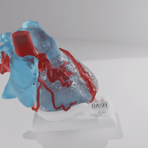 A heart model with a right coronary fistula, close up on the defect.