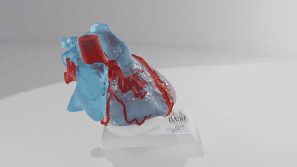 A heart model with a right coronary fistula, close up on the defect.