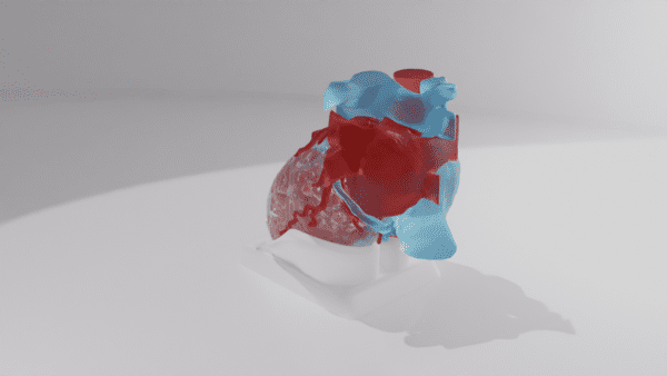 A heart model with a right coronary fistula, close up on the defect.