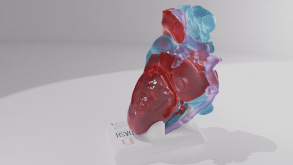 A model depicting a heart with a Total Pulmonary Venous Return defect