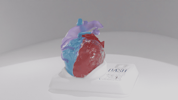 A heart model with a double outlet right ventricle defect