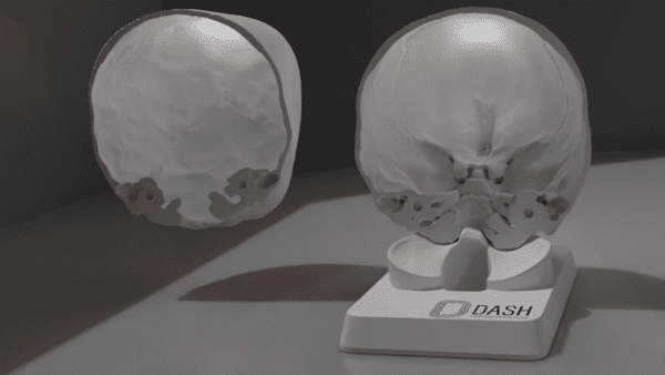 A model of a skull with metopic craniosynostosis