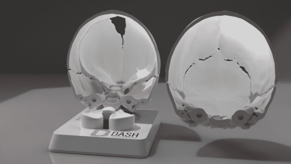 A 3D model of the skull of a 3mo with Sagittal Craniosynostosis, showing skull interior