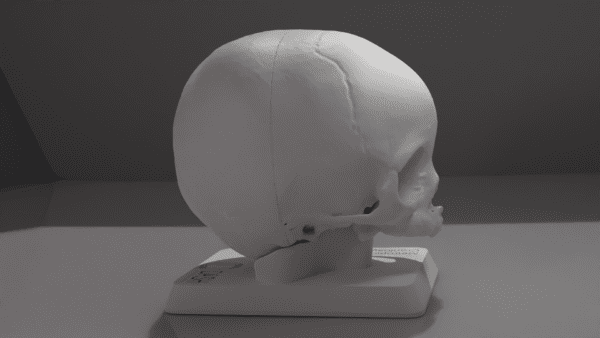 A model of a skull with metopic craniosynostosis