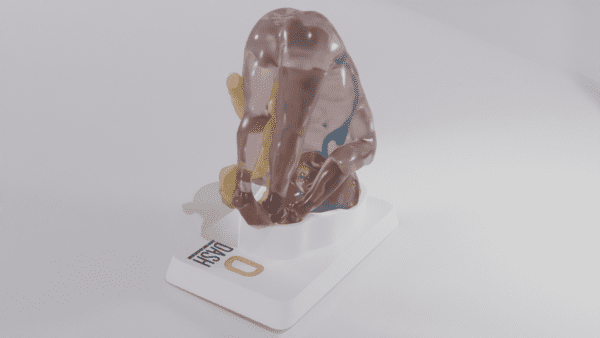 A model depicting a fetus with the occulta variation of the spina bifida