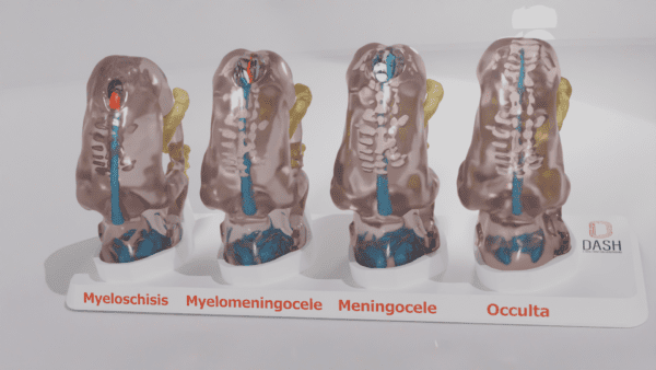 A set of four spina bifida types, seen from a posteror view