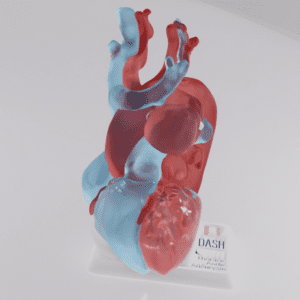 A model of a thoracic aneurysm seen from the anterior