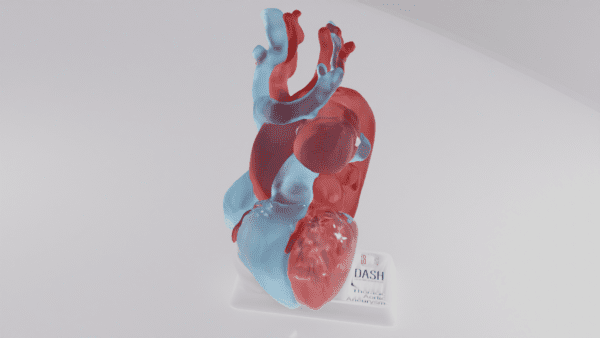A model of a thoracic aneurysm seen from the anterior