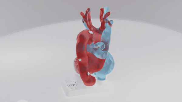 A model of a thoracic aneurysm seen from the posterior